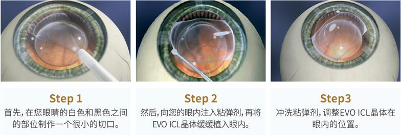 屈光矯視,希瑪瑞視眼科,上海眼科醫院