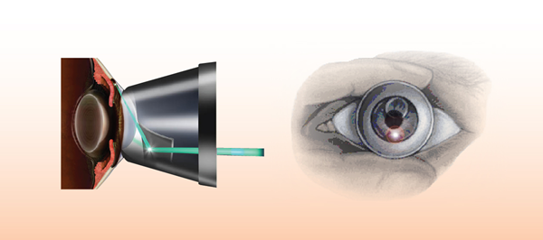 青光眼,希瑪瑞視眼科,上海眼科醫院