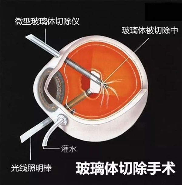 玻璃體視網膜,?，斎鹨曆劭?上海眼科醫院