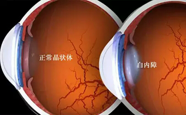 白內障,?，斎鹨曆劭?上海眼科醫院