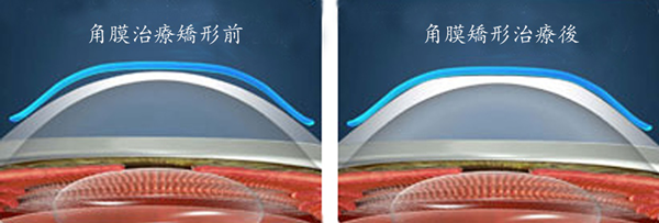 屈光矯視,希瑪瑞視眼科,上海眼科醫院 屈光矯視,希瑪瑞視眼科,上海眼科醫院