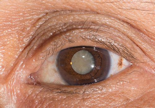 白內障,?，斎鹨曆劭?上海眼科醫院