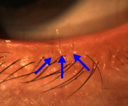 小兒眼病,?，斎鹨曆劭?上海眼科醫(yī)院
