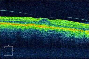 玻璃體視網膜,?，斎鹨曆劭?上海眼科醫院