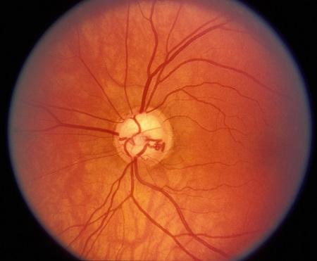 青光眼,希瑪瑞視眼科,上海眼科醫(yī)院