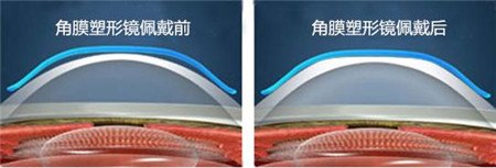 屈光矯視,?，斎鹨曆劭?上海眼科醫(yī)院