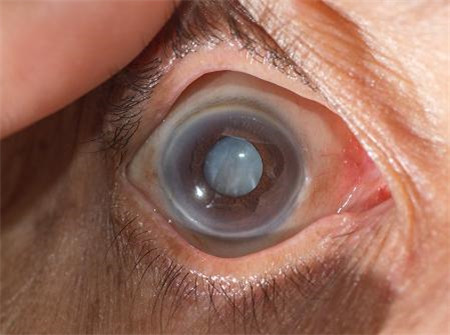 白內障,希瑪瑞視眼科,上海眼科醫院