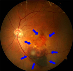 玻璃體視網膜,希瑪瑞視眼科,上海眼科醫院 玻璃體視網膜,希瑪瑞視眼科,上海眼科醫院