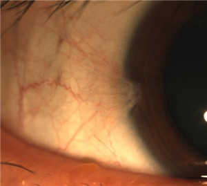 眼表眼角膜,?，斎鹨曆劭?上海眼科醫(yī)院