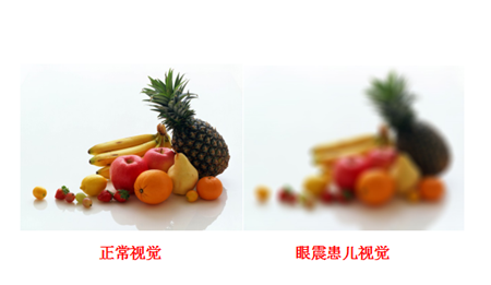 小兒眼病,希瑪瑞視眼科,上海眼科醫院