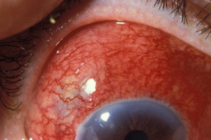 眼表眼角膜,希瑪瑞視眼科,上海眼科醫院 眼表眼角膜,希瑪瑞視眼科,上海眼科醫院