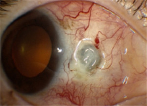 眼表眼角膜,希瑪瑞視眼科,上海眼科醫院 眼表眼角膜,希瑪瑞視眼科,上海眼科醫院