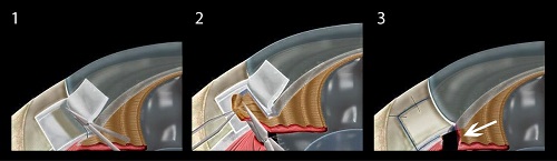 青光眼,希瑪瑞視眼科,上海眼科醫院