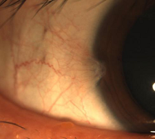 眼表眼角膜,希瑪瑞視眼科,上海眼科醫(yī)院 眼表眼角膜,希瑪瑞視眼科,上海眼科醫(yī)院