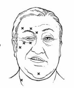 眼眶病,希瑪瑞視眼科,上海眼科醫院