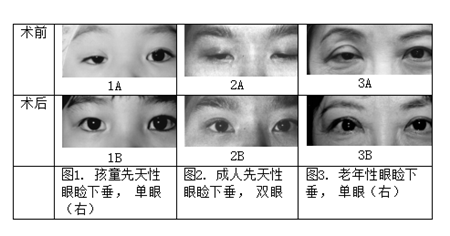 眼眶病,?，斎鹨曆劭?上海眼科醫院