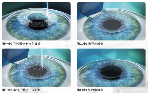 屈光矯視,希瑪瑞視眼科,上海眼科醫院 屈光矯視,希瑪瑞視眼科,上海眼科醫院