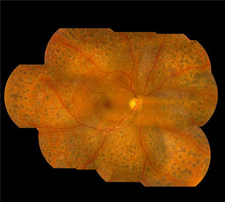 玻璃體視網膜,希瑪瑞視眼科,上海眼科醫院