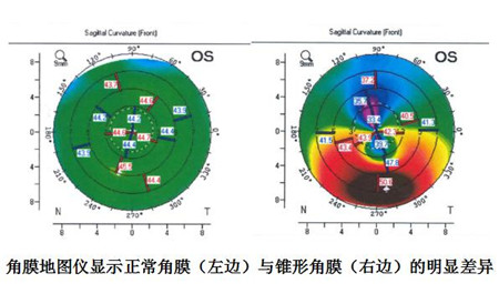 眼表眼角膜,希瑪瑞視眼科,上海眼科醫院 眼表眼角膜,希瑪瑞視眼科,上海眼科醫院
