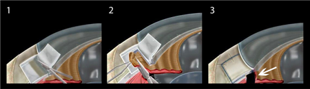 青光眼,?，斎鹨曆劭?上海眼科醫(yī)院