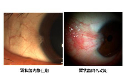 眼表眼角膜,希瑪瑞視眼科,上海眼科醫(yī)院