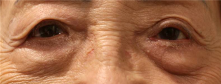 眼眶病,希瑪瑞視眼科,上海眼科醫院