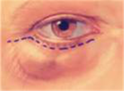 眼眶病,希瑪瑞視眼科,上海眼科醫院