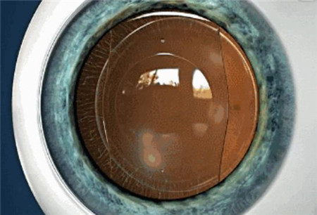 屈光矯視,希瑪瑞視眼科,上海眼科醫(yī)院 屈光矯視,希瑪瑞視眼科,上海眼科醫(yī)院