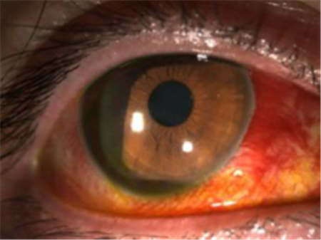 玻璃體視網膜,希瑪瑞視眼科,上海眼科醫院 玻璃體視網膜,希瑪瑞視眼科,上海眼科醫院