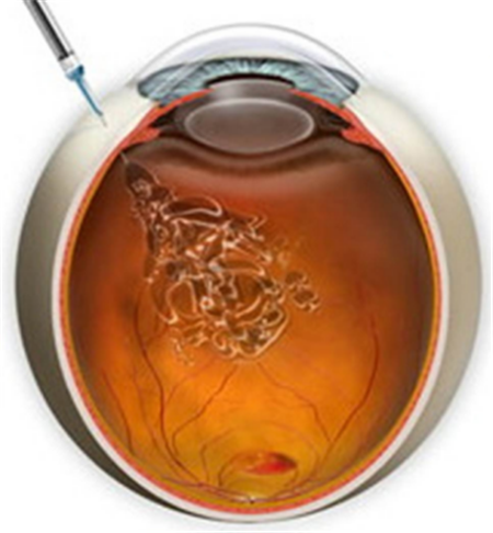 玻璃體視網膜,?，斎鹨曆劭?上海眼科醫院