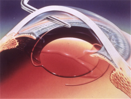 白內(nèi)障,?，斎鹨曆劭?上海眼科醫(yī)院