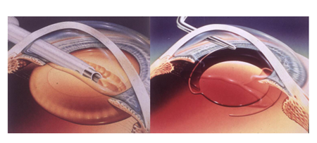 白內障,希瑪瑞視眼科,上海眼科醫院 白內障,希瑪瑞視眼科,上海眼科醫院