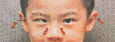 小兒眼病,希瑪瑞視眼科,上海眼科醫院