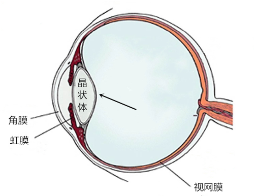 白內障,希瑪瑞視眼科,上海眼科醫院 白內障,希瑪瑞視眼科,上海眼科醫院