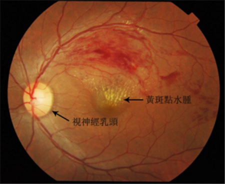 玻璃體視網(wǎng)膜,希瑪瑞視眼科,上海眼科醫(yī)院 玻璃體視網(wǎng)膜,希瑪瑞視眼科,上海眼科醫(yī)院