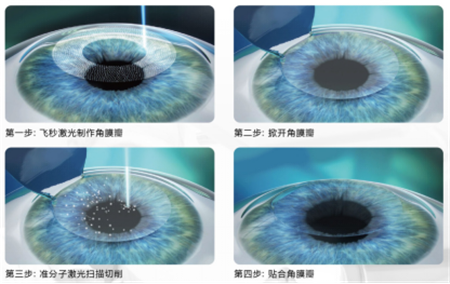 屈光矯視,?，斎鹨曆劭?上海眼科醫院