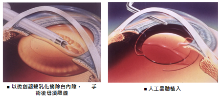 白內障,希瑪瑞視眼科,上海眼科醫院 白內障,希瑪瑞視眼科,上海眼科醫院
