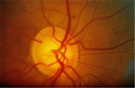 青光眼,?，斎鹨曆劭?上海眼科醫(yī)院