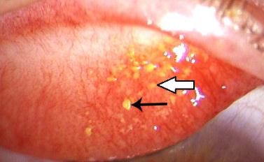 眼表眼角膜,希瑪瑞視眼科,上海眼科醫院 眼表眼角膜,希瑪瑞視眼科,上海眼科醫院