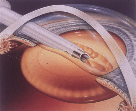 白內障,?，斎鹨曆劭?上海眼科醫院