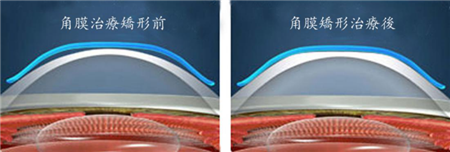 屈光矯視,希瑪瑞視眼科,上海眼科醫院 屈光矯視,希瑪瑞視眼科,上海眼科醫院