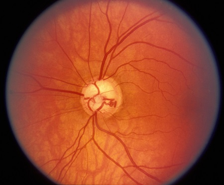 青光眼,希瑪瑞視眼科,上海眼科醫(yī)院 青光眼,希瑪瑞視眼科,上海眼科醫(yī)院