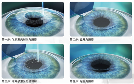 屈光矯視,希瑪瑞視眼科,上海眼科醫(yī)院 屈光矯視,希瑪瑞視眼科,上海眼科醫(yī)院