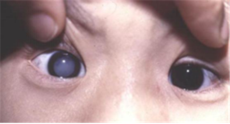 白內障,希瑪瑞視眼科,上海眼科醫院