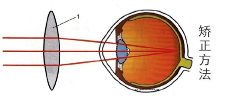 屈光矯視,希瑪瑞視眼科,上海眼科醫(yī)院 屈光矯視,希瑪瑞視眼科,上海眼科醫(yī)院