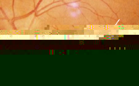 玻璃體視網(wǎng)膜,希瑪瑞視眼科,上海眼科醫(yī)院 玻璃體視網(wǎng)膜,希瑪瑞視眼科,上海眼科醫(yī)院