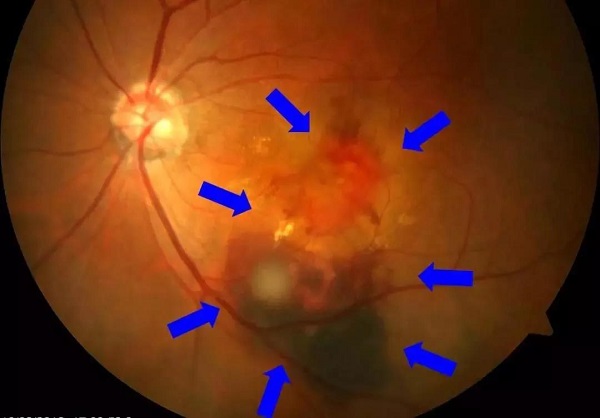 玻璃體視網(wǎng)膜,希瑪瑞視眼科,上海眼科醫(yī)院