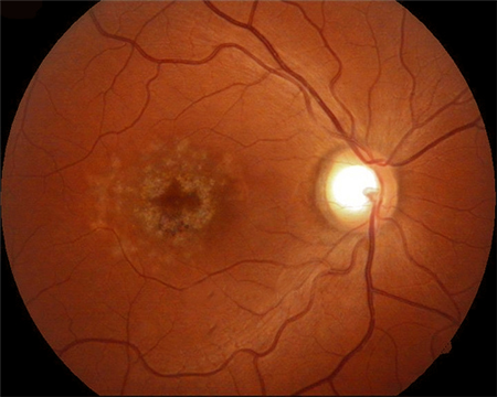 玻璃體視網膜,希瑪瑞視眼科,上海眼科醫院 玻璃體視網膜,希瑪瑞視眼科,上海眼科醫院