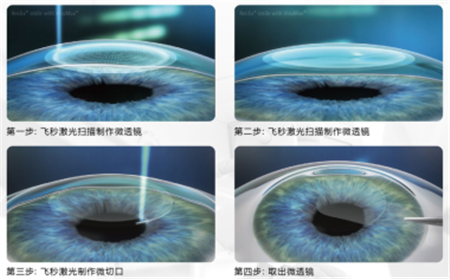 屈光矯視,希瑪瑞視眼科,上海眼科醫院