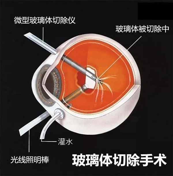 玻璃體視網膜,希瑪瑞視眼科,上海眼科醫院